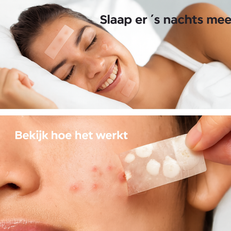 Luneo – Acne Patch Variety Pack | 126 stuks tegen puistjes en acne