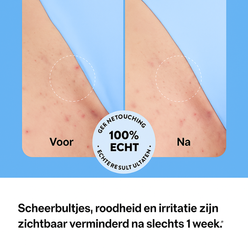 Luneo – Smooth Relief Roller | Tegen ingegroeide haren & irritatie