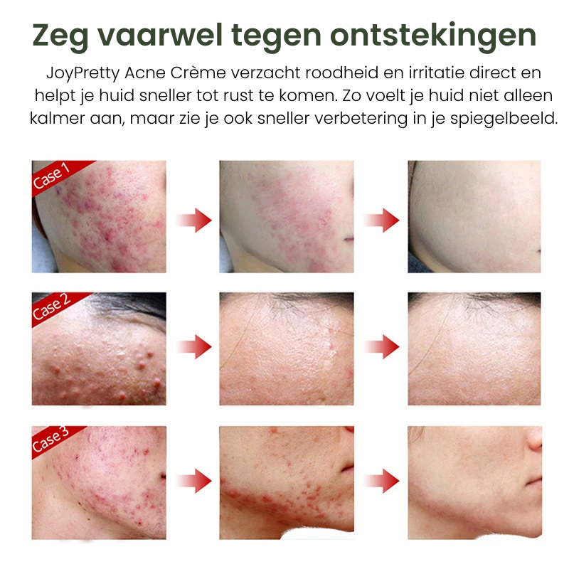 JoyPretty – Acne crème ontstekingen & littekens
